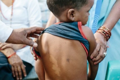 New Leprosy Cases - Ministry of Health Issues Statement